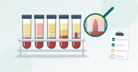 Schema: fünf Röhrchen im Edelstahl-Röhrchenträger nach der Zentrifugation, eines wie erwartet, vier mit rötlichem Plasma, Fibrinfäden, kleinem PRF-Gerinnsel und einer Lücke im Gel; eine Lupe vergrößert die Lücke, daneben eine Checkliste